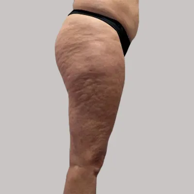 Cellulite Gesäß und Oberschenkel – Ausgangssituation vor der Behandlung