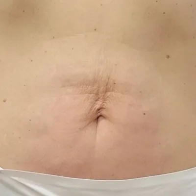 Straffung Bauch und Taille – Ergebnis nach zwölf Behandlungen