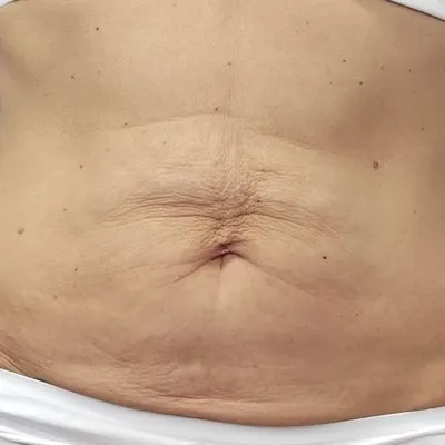 Straffung Bauch und Taille – Ausgangssituation vor der Behandlung